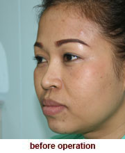 plastic_surgery_augmentation_rhinoplasty